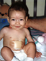 Day after Surgery